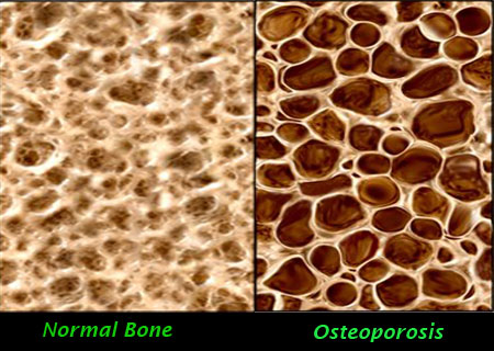 -NORMA BONE- OSSO NORMAL.
-OSTEOPOROSIS- OSSO COM OSTEOPOROSE